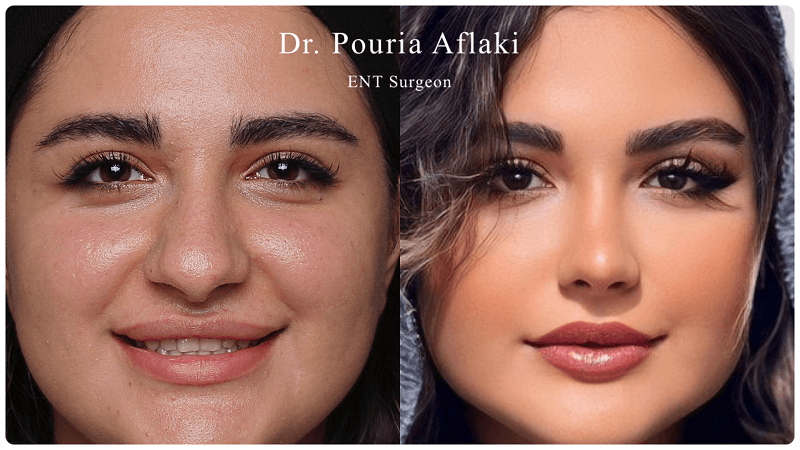 فاشیا (Fascia) و نقش آن در عمل بینی ترمیمی