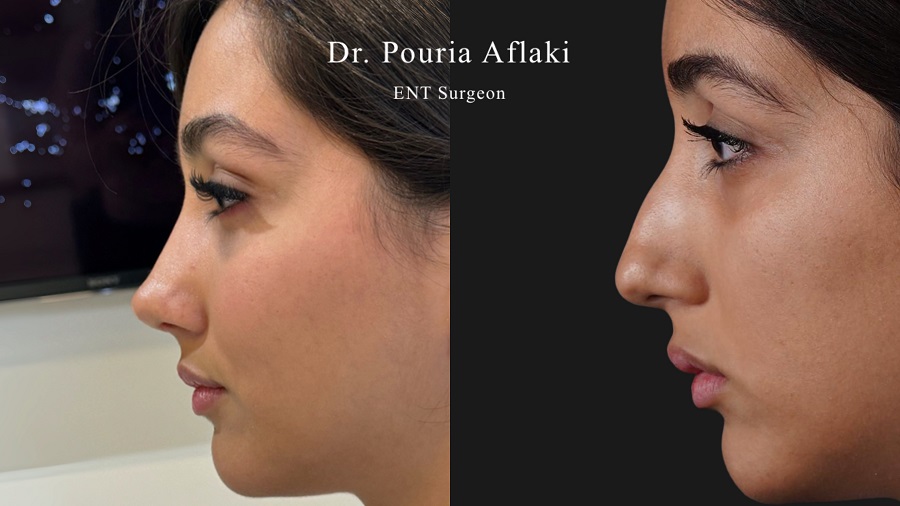 راهنمای تخصصی جراحی بینی؛ عمل بینی گوشتی، ترمیمی و انحراف