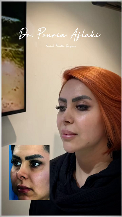 نتیجه عمل ترمیمی بینی
