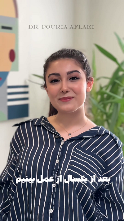 نتیجه جراحی زیبایی بینی بعد از یکسال